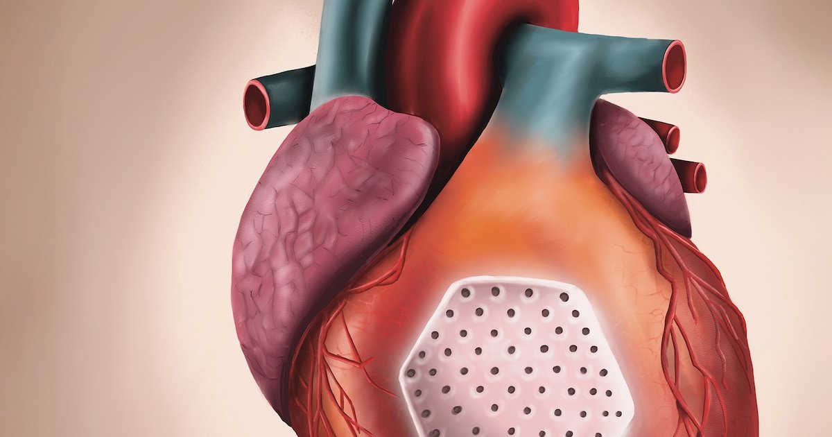 Crean un parche de células madre que podría mejorar la función del corazón en casos de insuficiencia cardíaca