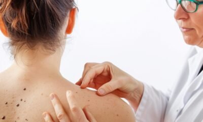 Lunares y pecas aparecen cuando hay mayor exposición al sol, señalan expertos