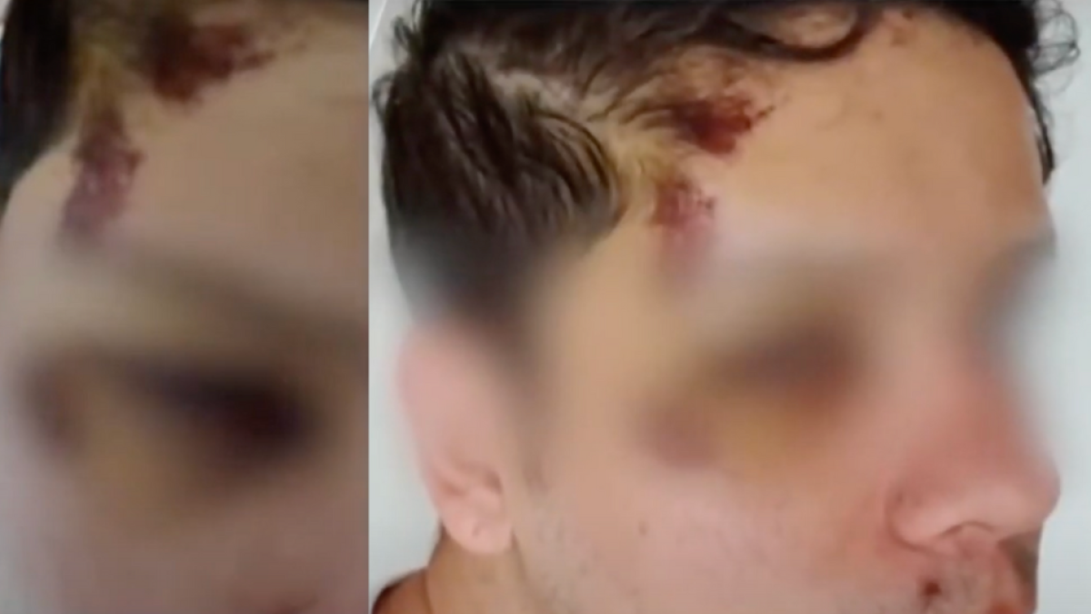 Joven Sufrió Violento Robo en Centro de Bogotá Cuando Iba A Tomar Transmilenio: Quedó Desorientado Por Los Golpes