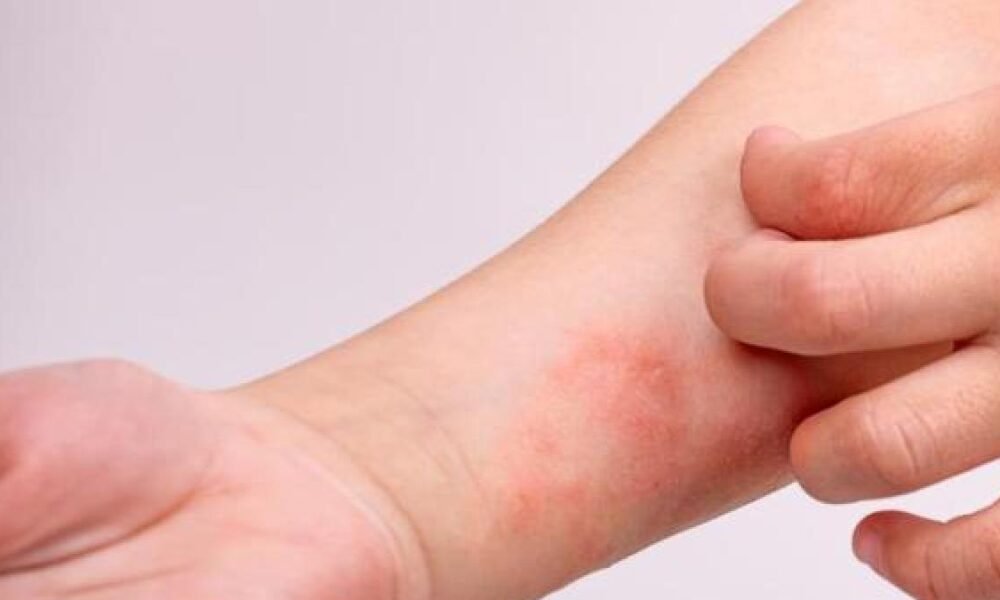 Alerta sanitaria en soldad (Atlánnico) Por Cano Confirmado de Sarampión en Pasajera Proveniente de San Andrés