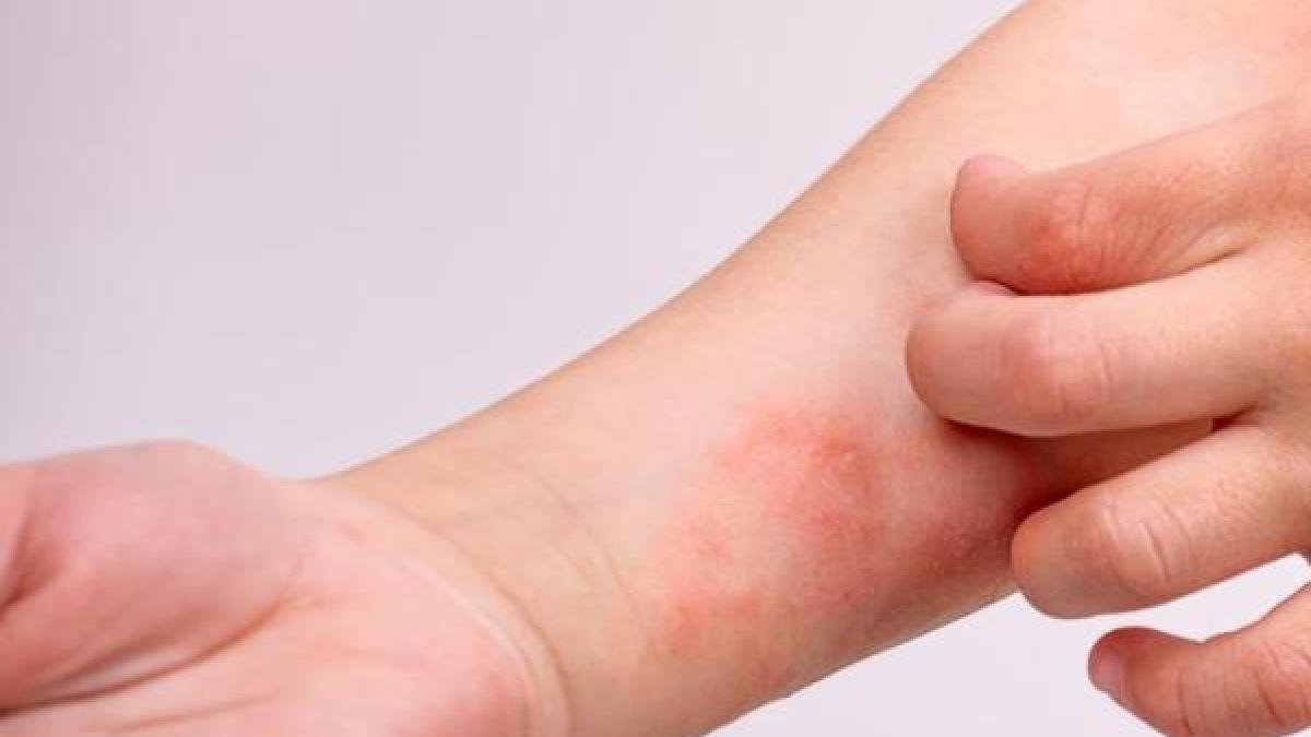 Alerta sanitaria en soldad (Atlánnico) Por Cano Confirmado de Sarampión en Pasajera Proveniente de San Andrés