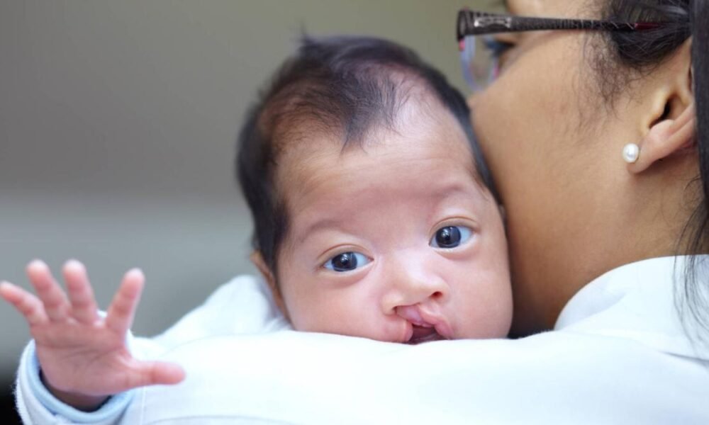 Médicos Especializados Realizarán Cirugías Grastuitas para Niños Con Labio Leporino del 6 al 10 de Junio