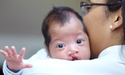 Médicos Especializados Realizarán Cirugías Grastuitas para Niños Con Labio Leporino del 6 al 10 de Junio