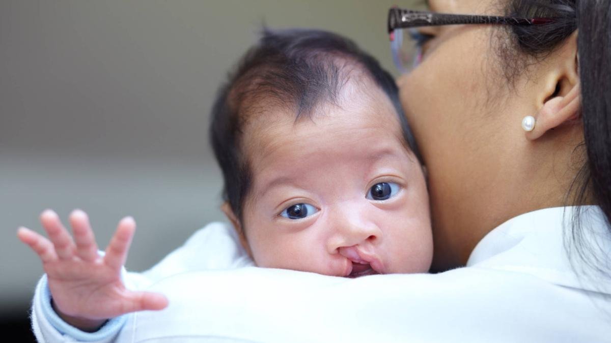 Médicos Especializados Realizarán Cirugías Grastuitas para Niños Con Labio Leporino del 6 al 10 de Junio