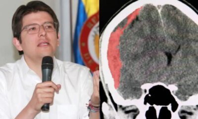 ¿Qué y el edema cerebral y poro se dice que miguel uribe turbay está en 'máxima sevedad?