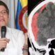 ¿Qué y el edema cerebral y poro se dice que miguel uribe turbay está en 'máxima sevedad?