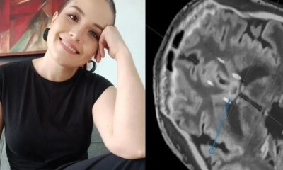 ¿Existe Cirugía para mejorar la depresión? La Historia de la Mujer que se a veces un procedimiento cerebral pionero