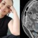 ¿Existe Cirugía para mejorar la depresión? La Historia de la Mujer que se a veces un procedimiento cerebral pionero
