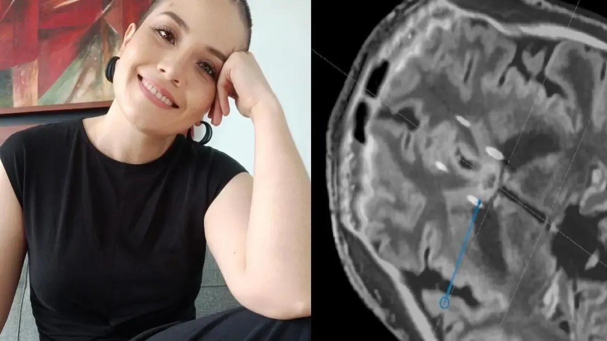 ¿Existe Cirugía para mejorar la depresión? La Historia de la Mujer que se a veces un procedimiento cerebral pionero
