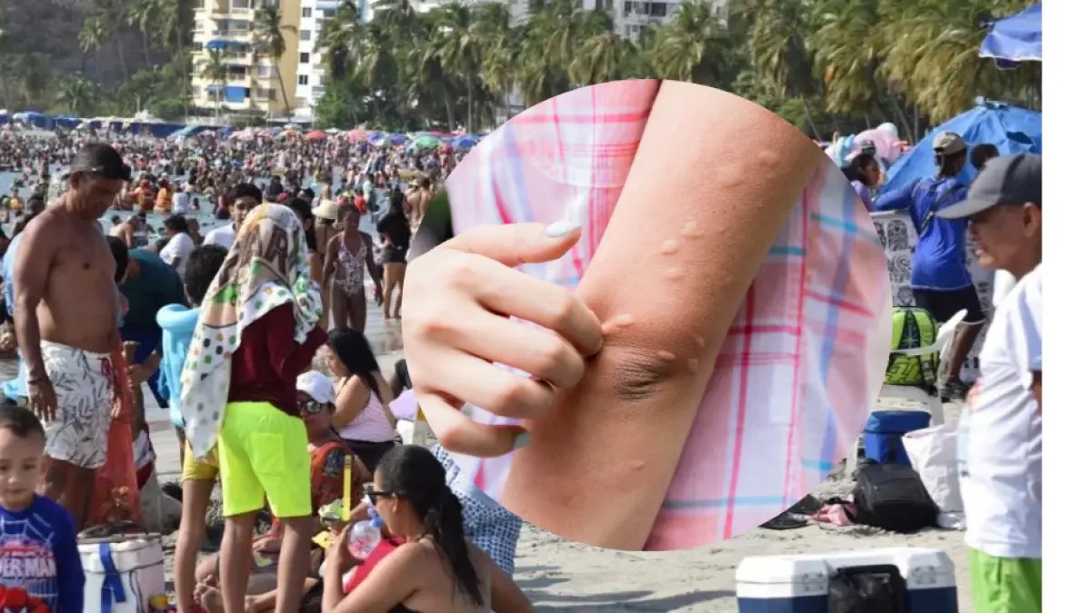 Bañistas Brotes denuncianos en la Piel Tras Ingesar Al Mar en Santa Marta; Mujer Afectada Cuenta Su Experimencia