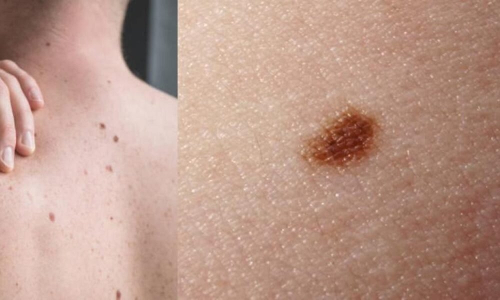 Jornada Gratuita de Chequeo de Lunares Busca Prevenir Cáncer de Piel