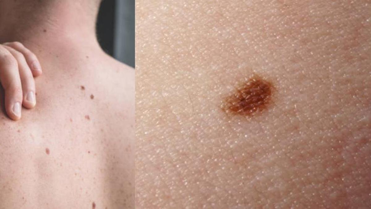 Jornada Gratuita de Chequeo de Lunares Busca Prevenir Cáncer de Piel