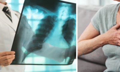 El Dadis Informa Más de 300 Casos de tuberculosis en lo que va del 2025