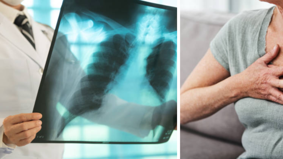 El Dadis Informa Más de 300 Casos de tuberculosis en lo que va del 2025