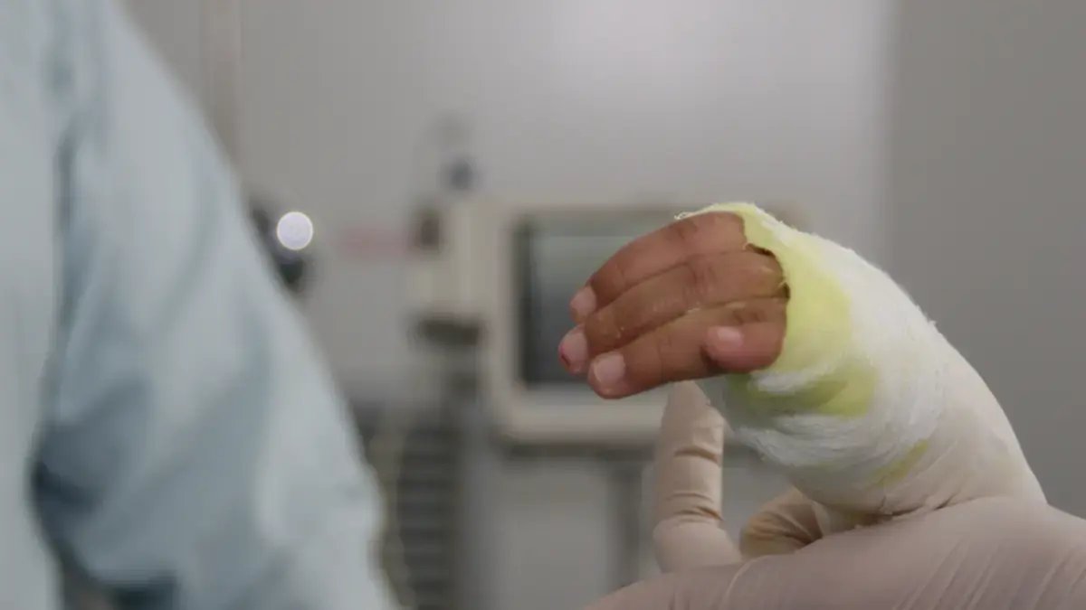 En Menos de dos Años, 34 Personas Han resultado Con Quemaduras Graves Por el Uso de Chimeneas y Califactores con bioetanol en bogotá