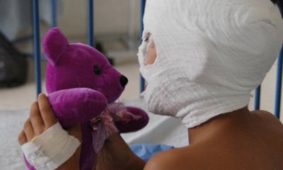 Más de 30 personas han resultado quemadas por pólvora en Nariño; una de las víctimas es un niño de 4 años con lesiones en el rostro y daño en sus ojos