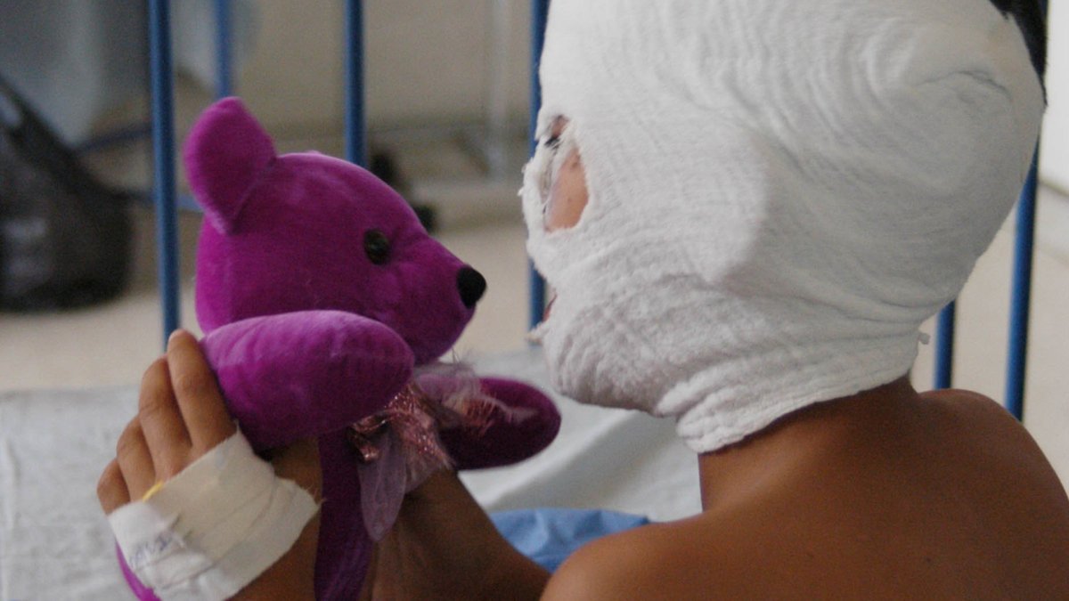 Más de 30 personas han resultado quemadas por pólvora en Nariño; una de las víctimas es un niño de 4 años con lesiones en el rostro y daño en sus ojos
