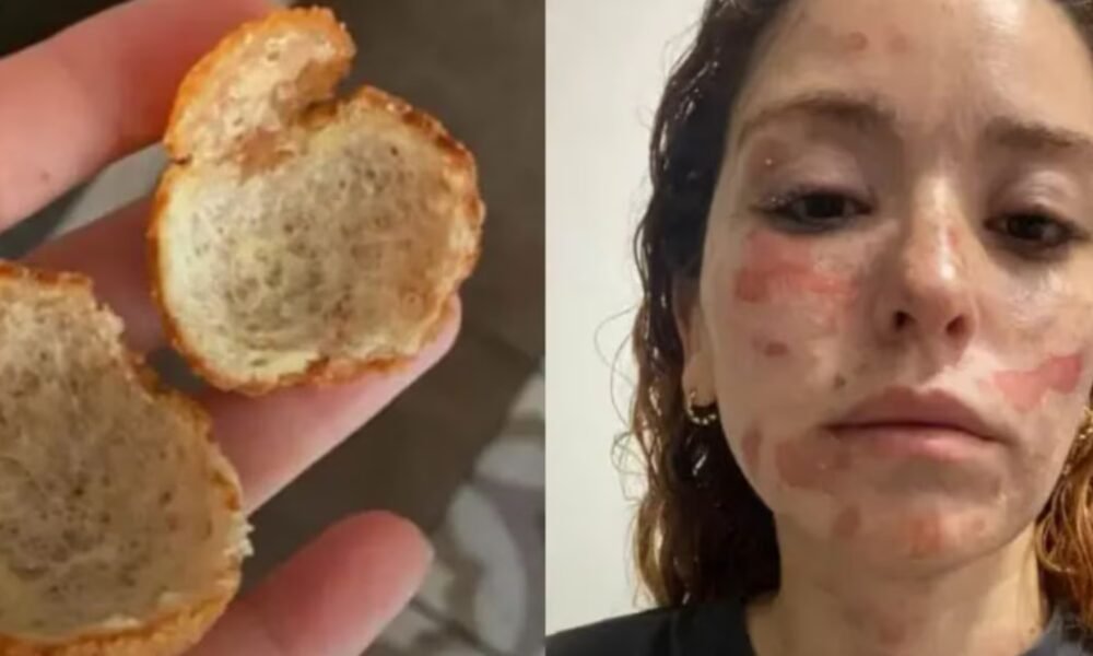 Mujer relata las graves quemaduras que sufrió tras la explosión de un buñuelo: “Cómprenlos, no los hagan”