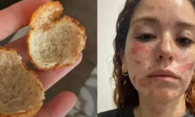 Mujer relata las graves quemaduras que sufrió tras la explosión de un buñuelo: “Cómprenlos, no los hagan”