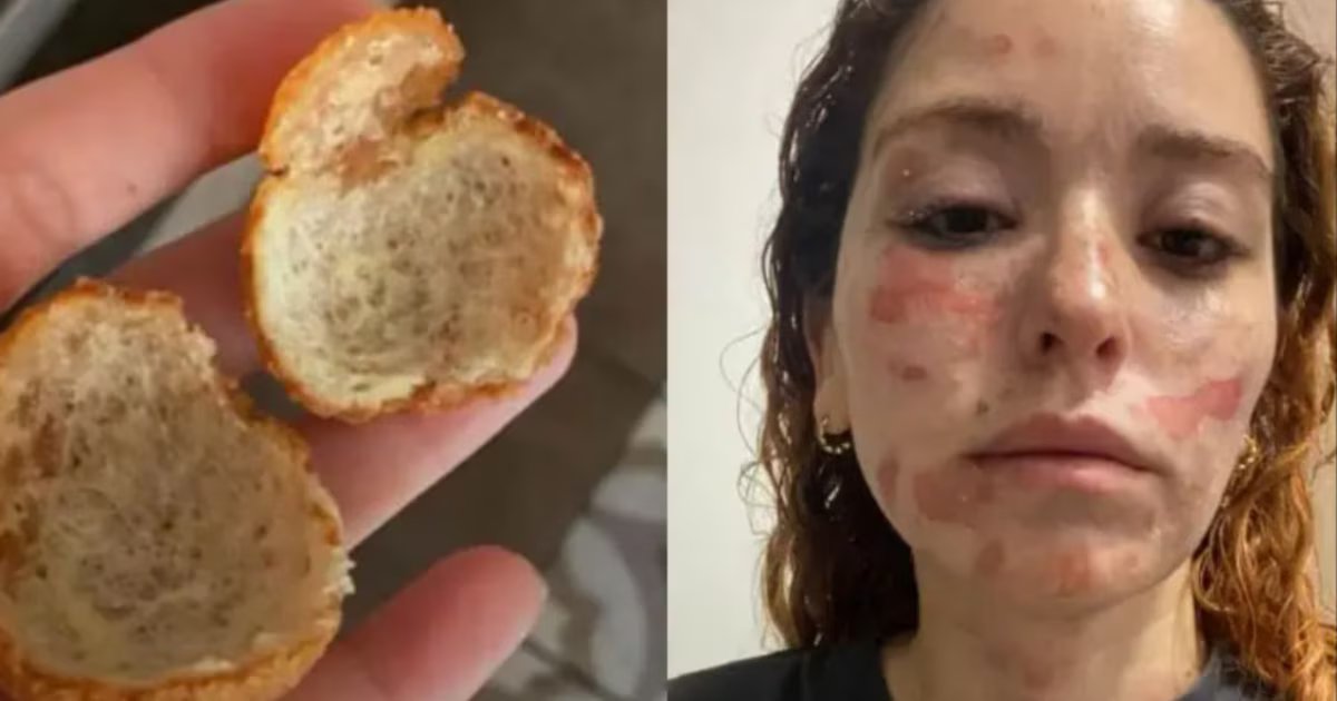 Mujer relata las graves quemaduras que sufrió tras la explosión de un buñuelo: “Cómprenlos, no los hagan”