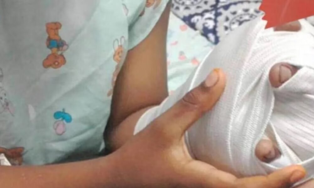 Autoridades alertan por quemados con pólvora en Córdoba: 69 casos reportados, según Sivigila