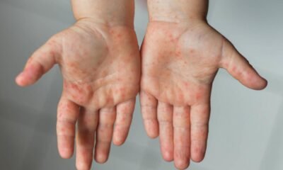 ¿En qué municipio hubo contagio? autoridades prenden las alarmas