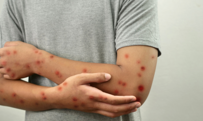 ¿Cómo va la activación del cerco epidemiológico tras detectar caso importado de sarampión?