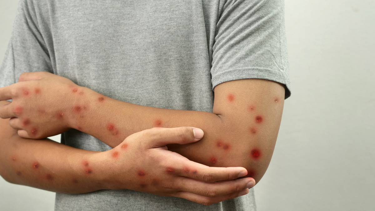 ¿Cómo va la activación del cerco epidemiológico tras detectar caso importado de sarampión?