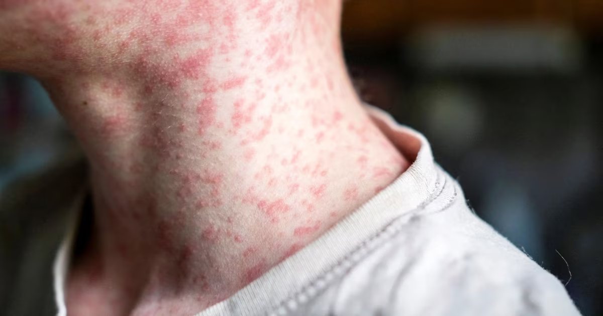 Estos son los tres casos de sarampión que confirmó el Ministerio de Salud y que activa la vigilancia epidemiológica en el país