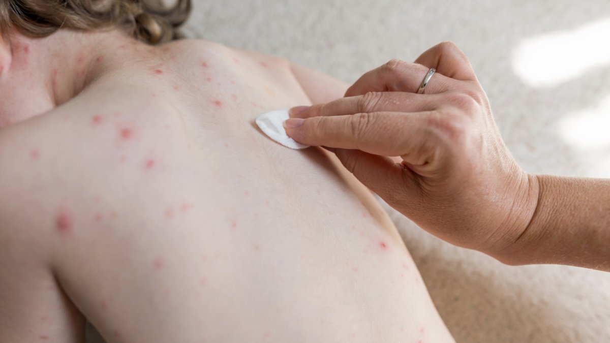 Cartagena blinda el aeropuerto, hoteles y puerto ante el regreso al país del sarampión, tras seis años de silencio del brote