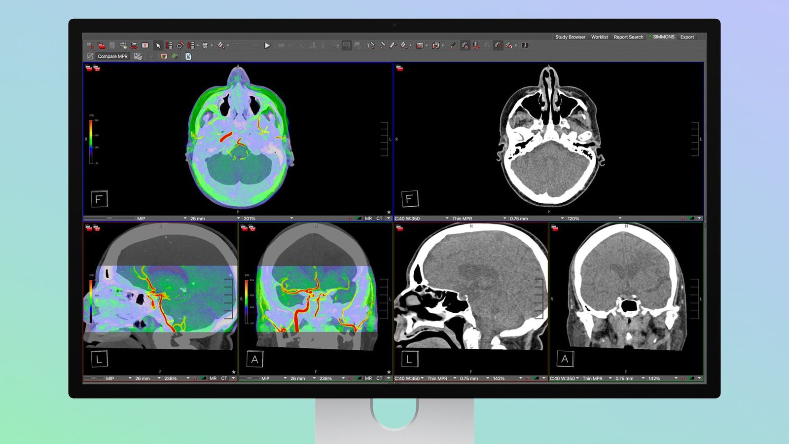 Studio Display XDR de Apple admite imágenes médicas DICOM para radiología de diagnóstico