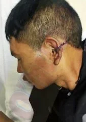 agresión en riña callejera — Hombre agredido en riña sufre fractura y requiere traslado a Pereira