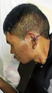agresión en riña callejera — Hombre agredido en riña sufre fractura y requiere traslado a Pereira