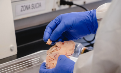 terapia Alzhéimer Antioquia — Terapia Alzhéimer Antioquia: UdeA inicia ensayo con fármacos combinados