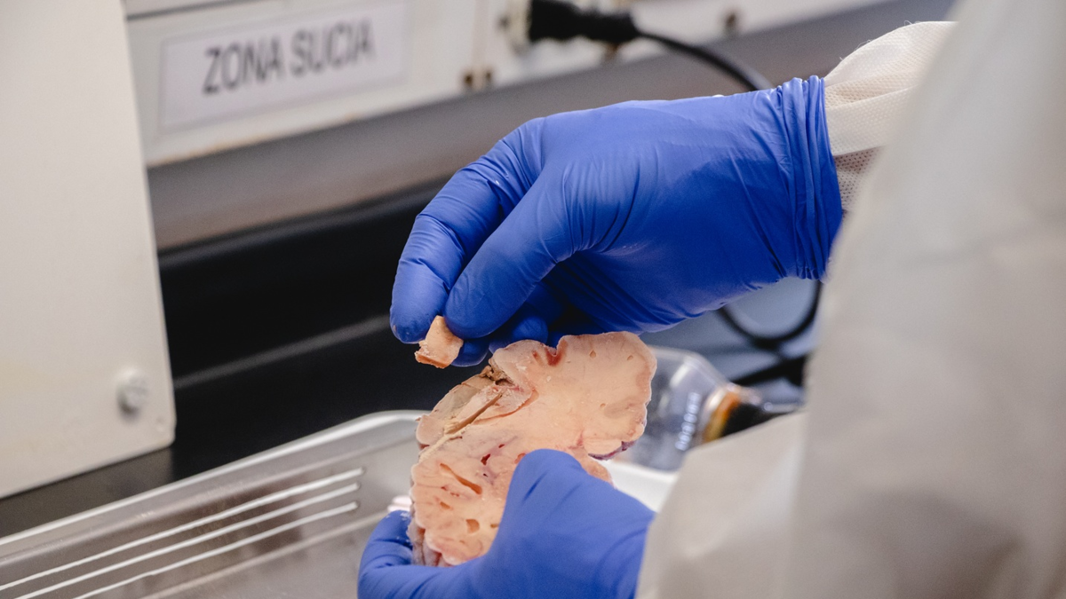 terapia Alzhéimer Antioquia — Terapia Alzhéimer Antioquia: UdeA inicia ensayo con fármacos combinados