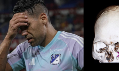 fractura arco cigomático — Falcao sufre fractura arco cigomático: Millonarios confirma lesión