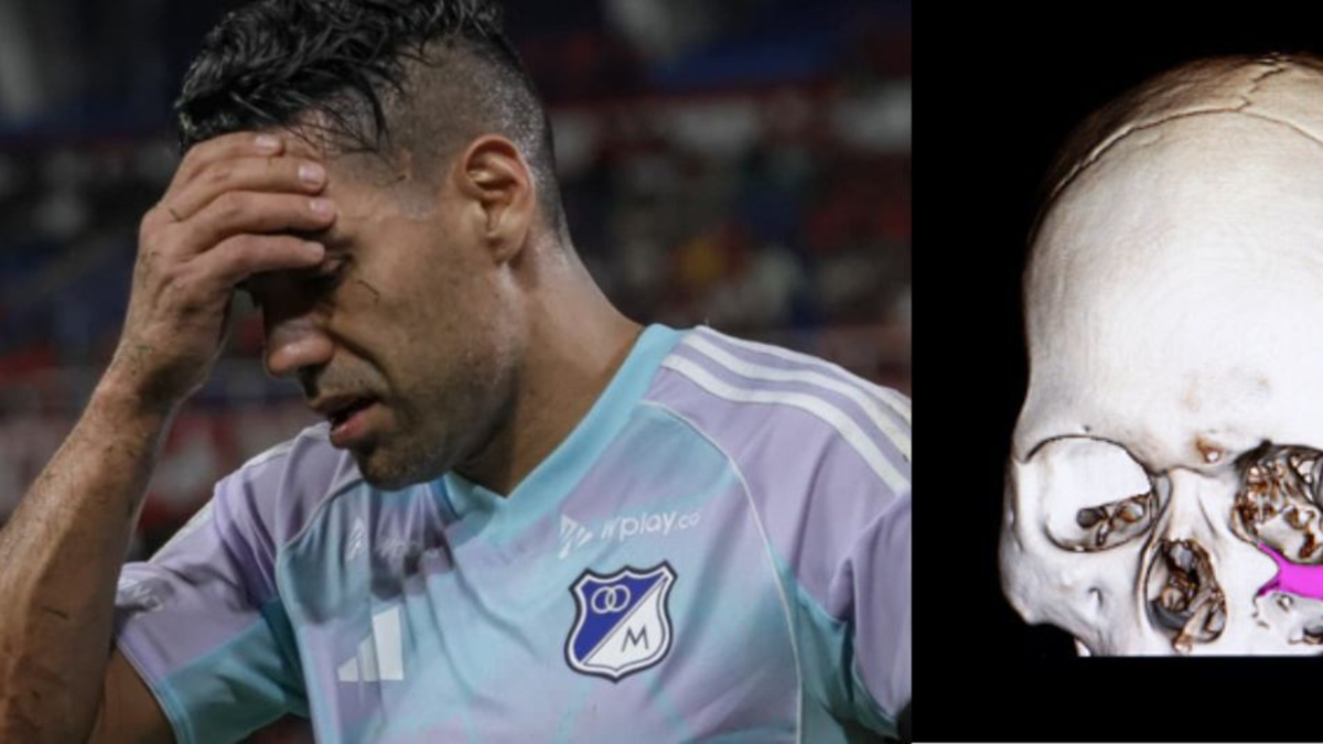 fractura arco cigomático — Falcao sufre fractura arco cigomático: Millonarios confirma lesión