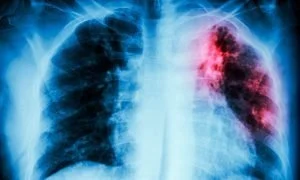 tuberculosis en Risaralda — Tuberculosis en Risaralda: un panorama con cifras destacadas en 2025