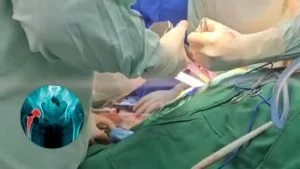 reemplazo de cadera — Hospital San Pedro y San Pablo Realiza Primera Cirugía de Reemplazo de Cadera