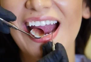 Caries dental — Caries dental: Prevención, causas y factores de riesgo